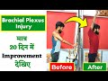 Brachial plexus injury treatment  best exercises in brachial plexus injury  dr deepak soni