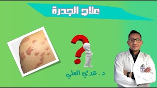 علاج الجدرة