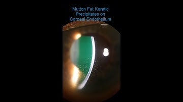Intermediate Uveitis - Vitritis & Mutton Fat KPs