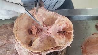 Dural folds and Dural venous sinuses - Gross Anatomy ( Dissection )