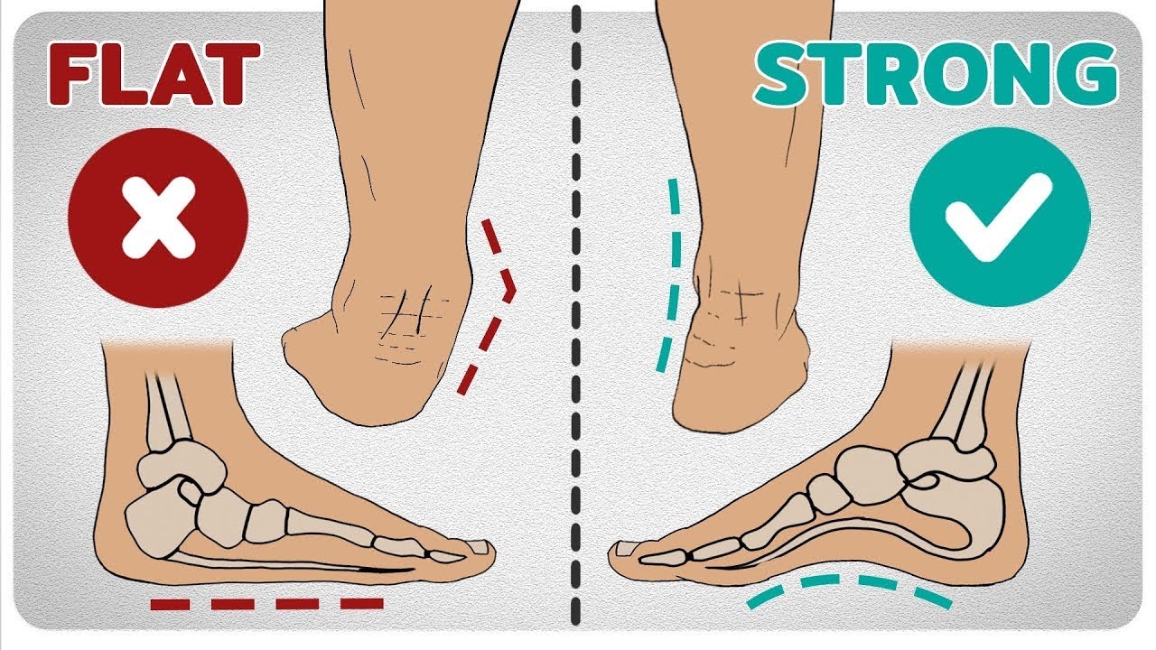 High Arches: The Secret to Pain-Free Running