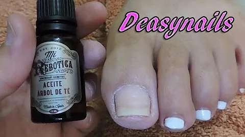 ¿Se puede aplicar aceite del árbol del té directamente sobre los hongos de las uñas de los pies?