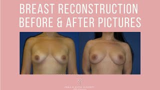 Breast Reconstruction Before & After Pictures | Photo Gallery