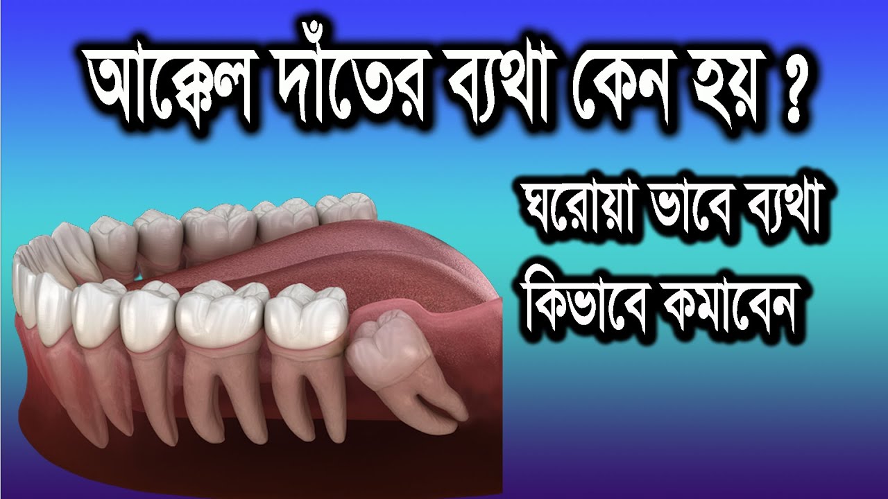 আক্কেল দাঁতের ব্যথার কারন Wisdom Teeth Pain Relief In Bangla Akkel
