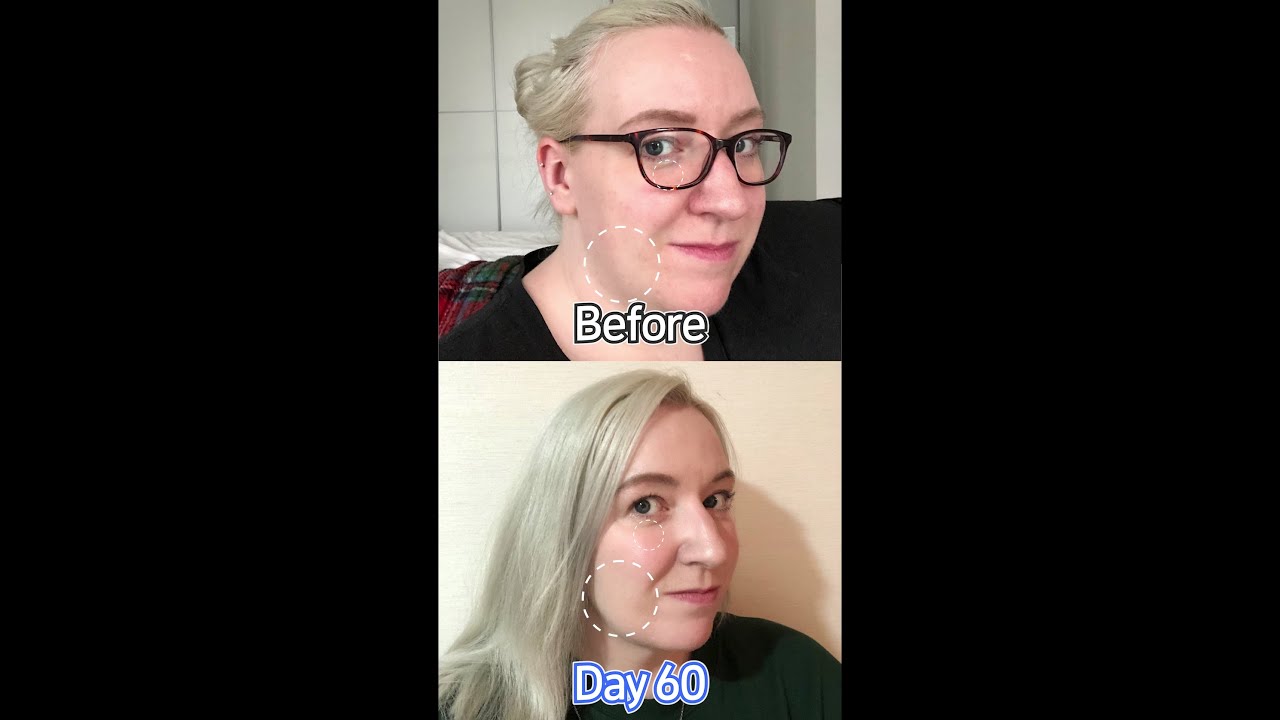 Эйтоп Гоо сайхны Мэс Заслын Эмнэлэг: Мэс заслын өмнө ба дараах зураг & видеог харьцуулах~😊 #Лифтинг #НүднийДоорхГооСайхныМэсЗасал #shorts