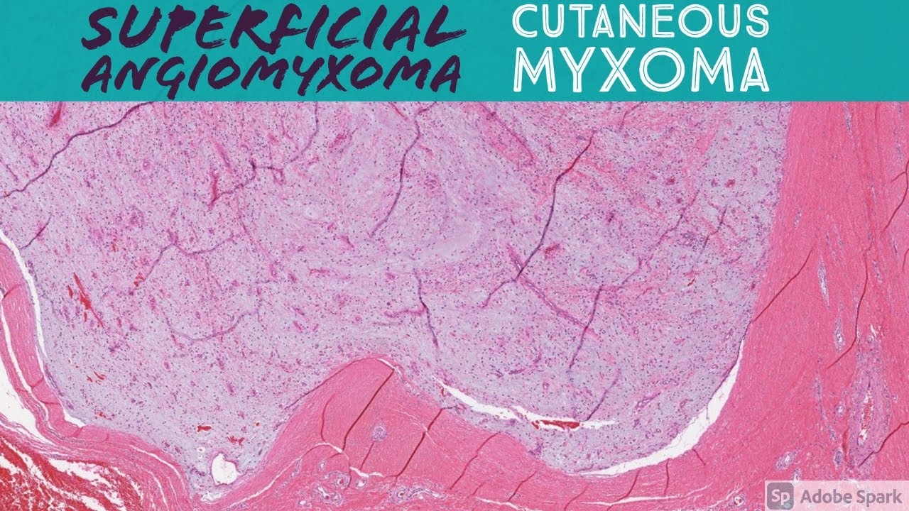 Cutaneous Myxoma (aka Superficial Angiomyxoma) YouTube