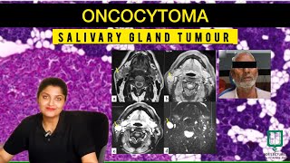 Oncocytoma | Lecture 41 | Salivary Gland Tumour | Oral Pathology | NEET MDS | BDS | MDS | Dentistry