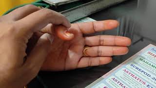 Trigger Thumb In Telugu... Dr Sai Chandra