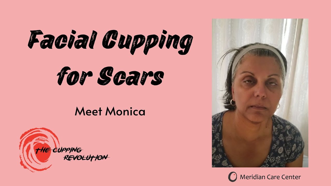 Facial cupping scar treatment testimonial YouTube