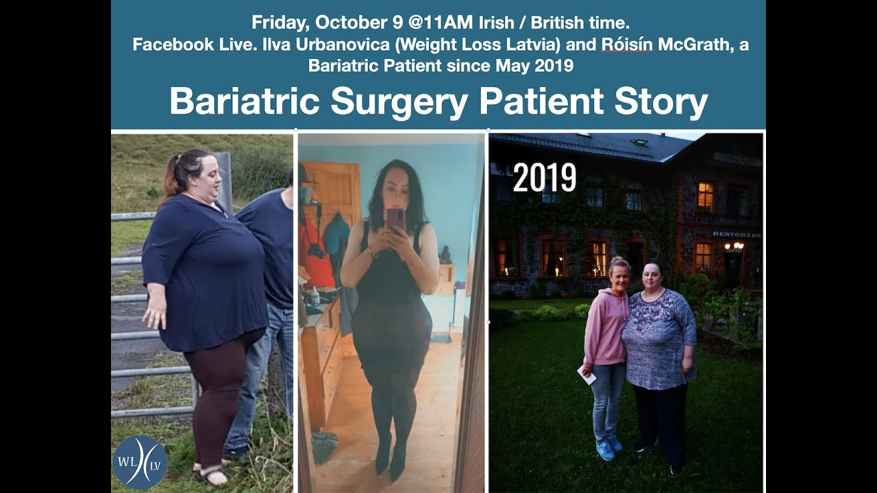 Gastric Bypass Patient Story. Weight Loss Latvia