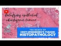CEOT Histopathology MUST KNOW FEATURES CEOT Histopathology MUST KNOW FEATURES