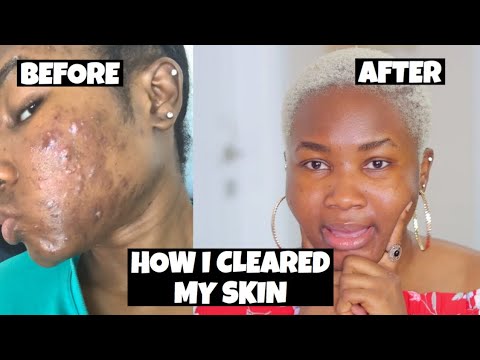 The Price Of Perfect Skin: My Accutane Trauma
