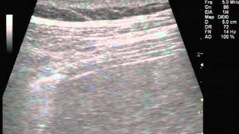Ultrasonography of Normal and Paralyzed Diaphragms