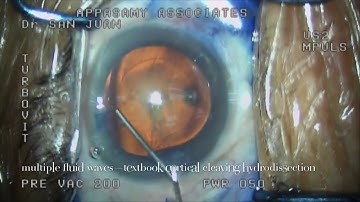 Cortical Cleaving Hydrodissection with Multiple Fluid Waves