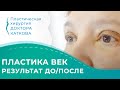 Верхняя блефаропластика. До и после