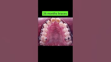 Quá trình niềng răng 26 tháng #braces #orthodontist