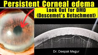 Inferior Descemets Membrane Detachment Dmd Management Dr Deepak Megur