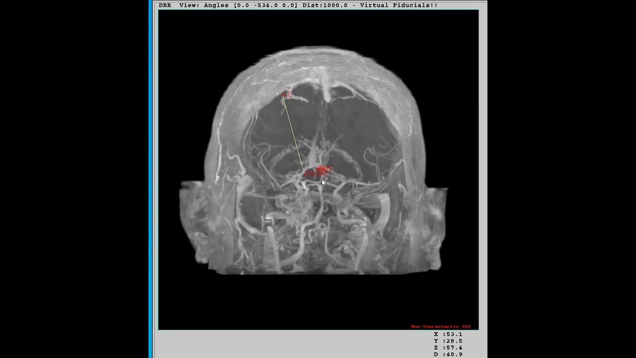 MNPS: Maximum Intensity Projection (MIP) in Stereotactic Space