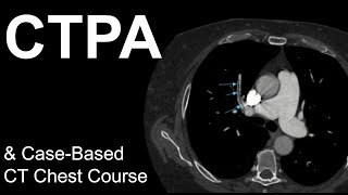 CT Pulmonary Angiogram: Pulmonary Embolism, Case-Based Course