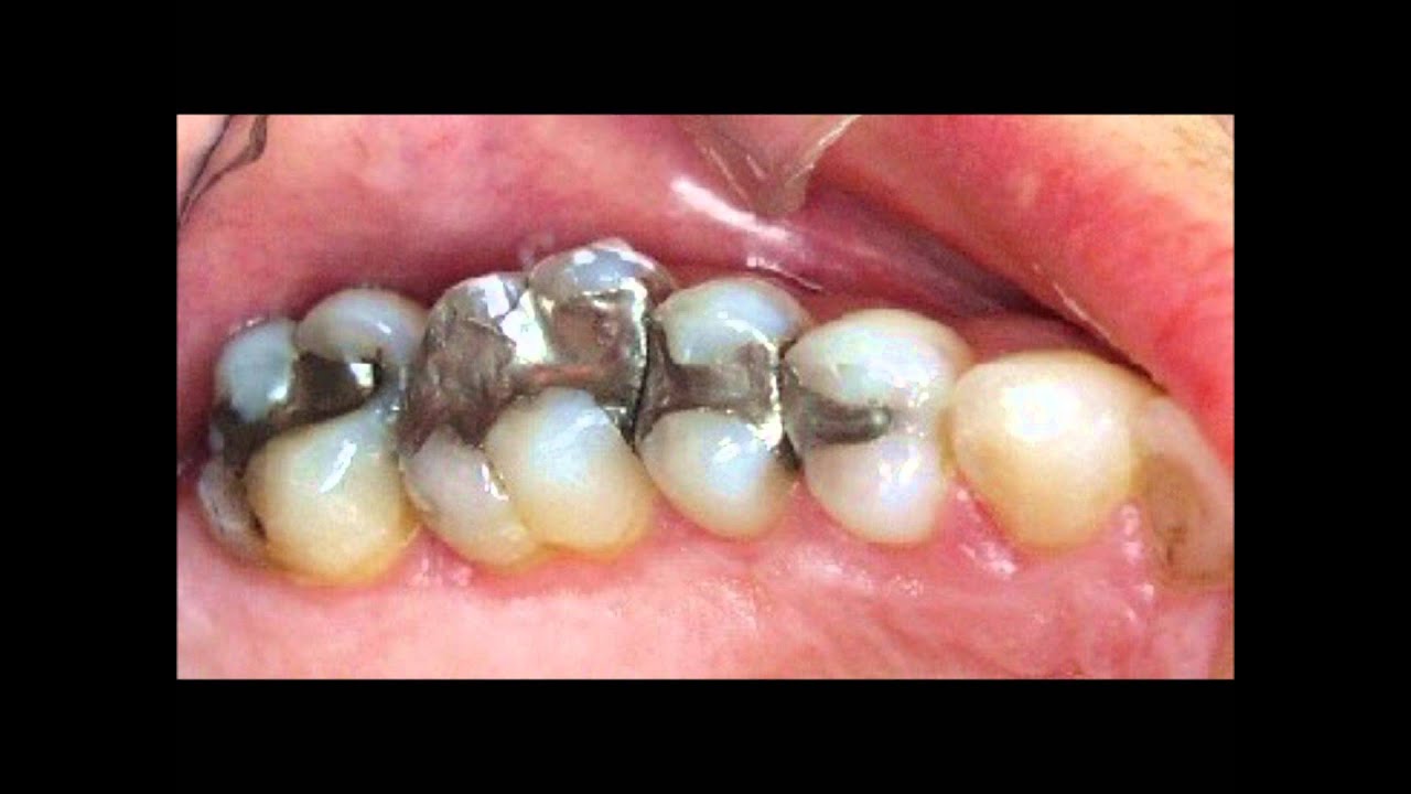 Reasons to Replace Amalgam Fillings YouTube