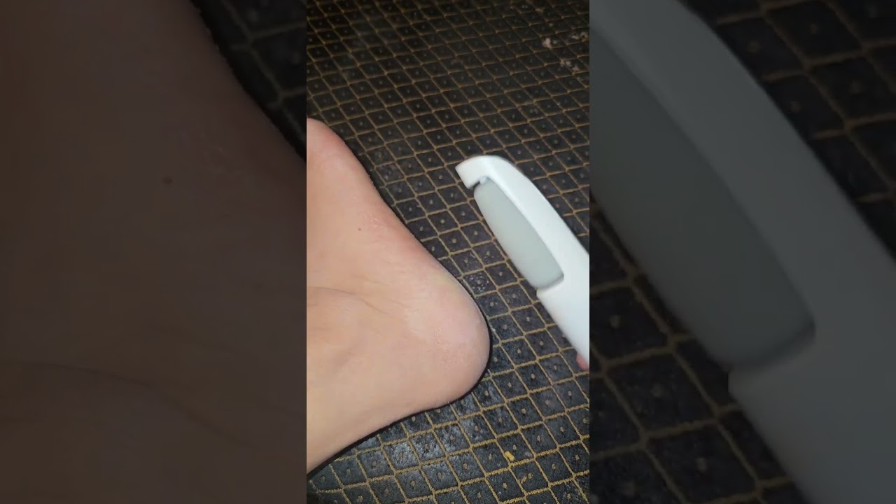 Don't let cracked heels hold you back! 