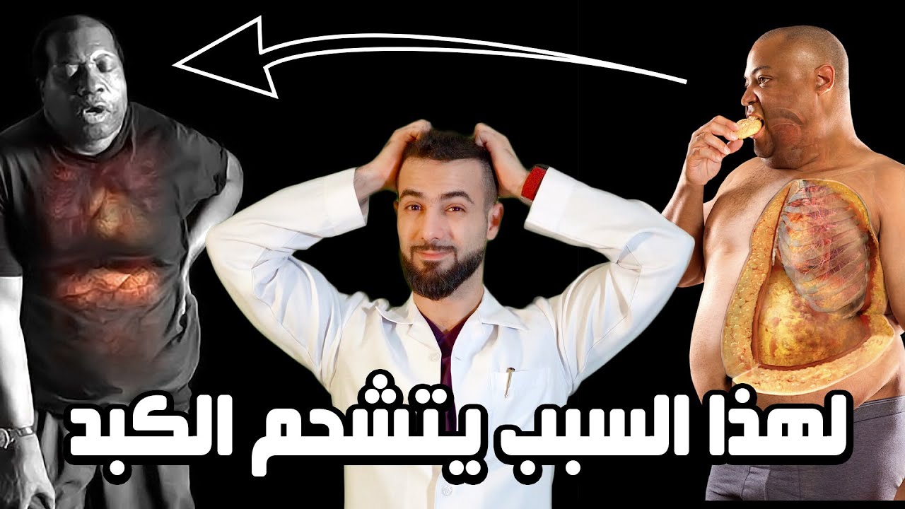 علاج سموم الكبد الدهني || شرح رائع لعلاج تشحم الكبد واعراضه بدون ادويه