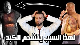 علاج سموم الكبد الدهني || شرح رائع لعلاج تشحم الكبد واعراضه بدون ادويه