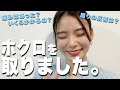 【実体験】顔のホクロを取りました!費用など全てをお話しします【朝日奈央】