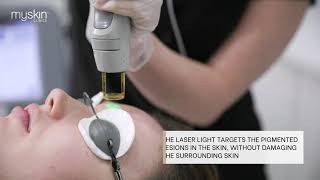 Pigmentation Removal | MySkin Clinics