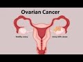 Meaning Of Ovarian Cancer