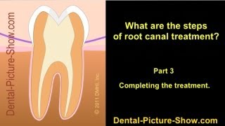 Root canal treatment steps. - Part 3