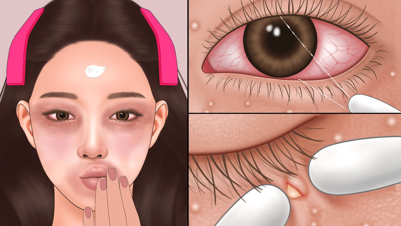 ASMR 소름 쫙~실눈곱 제거 | 오돌토돌 비립종 압출 애니메이션 | Eye Mucus Fishing Syndrome Removal | Milium Extraction