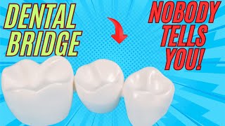 What nobody will tell you about a Dental Bridge