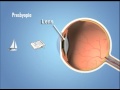 Presbyopia