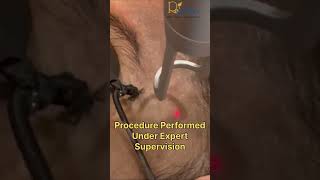 জন্মগত মুখের দাগ কমানোর উপায় | Nevus of Ota Treatment