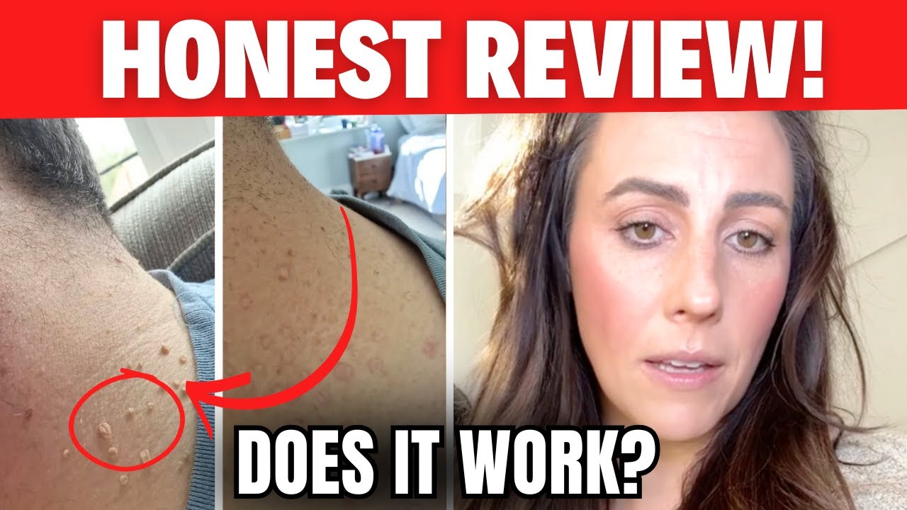Derma Clear Skin Tag Remover Reviews Reddit Derma Clear Skin Tag Remover - (( MY HONEST REVIEW!! )) - DERMA CLEAR
