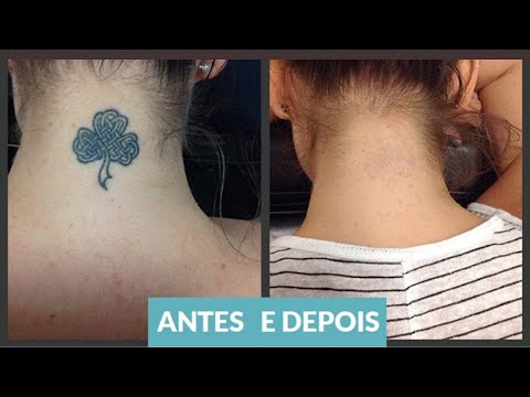 Vídeo: Como Apagar Tatuagens Como Victoria Beckham