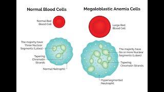 Treatment options for Megaloblastic Anemia