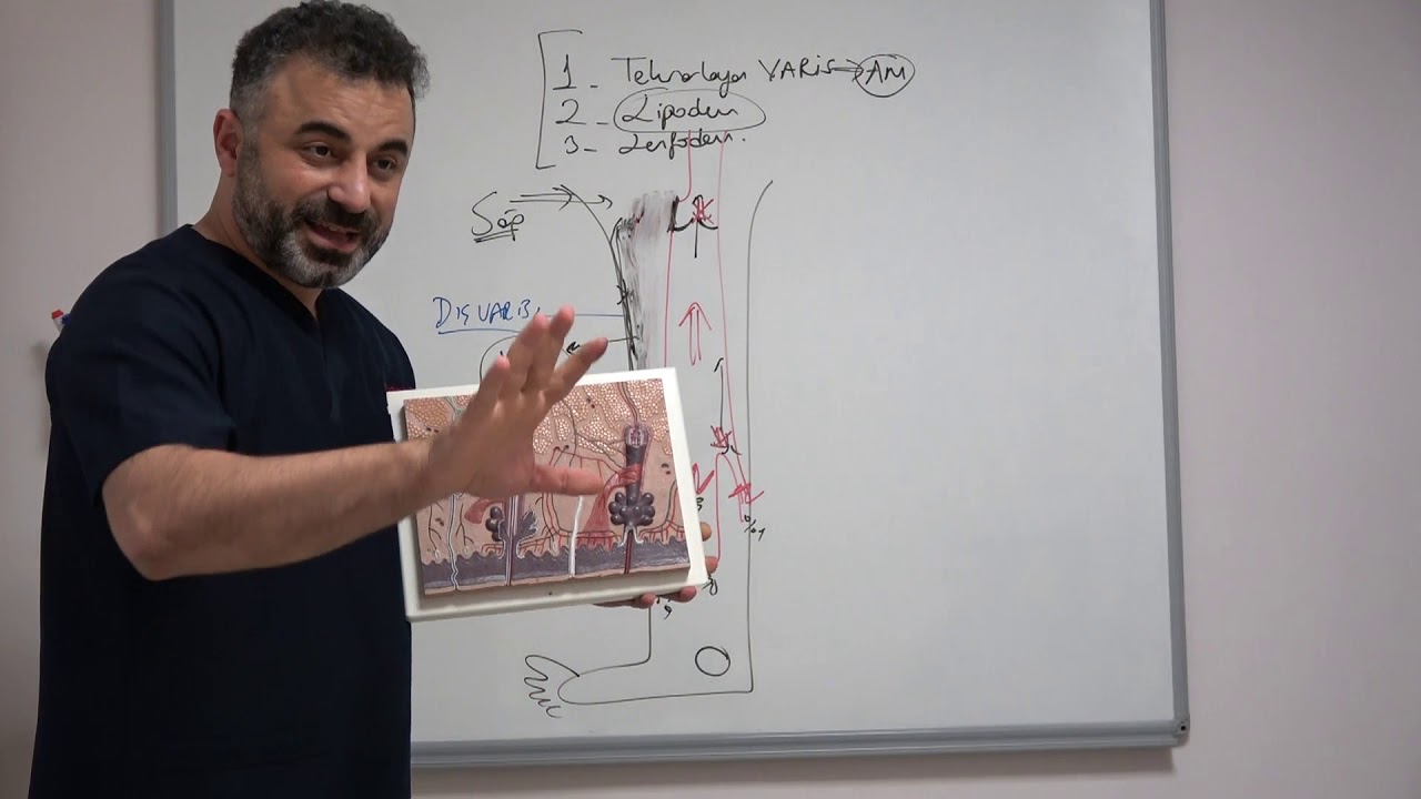 Varis tedavisi sonrası tekrarlayan Varisler ve bacakta şişlik ve ağrılar - Prof. Dr. Ahmet AKGUL