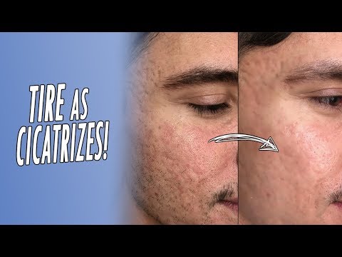 TUDO SOBRE CICATRIZES DE ACNE, DERMAROLLER EM CASA E MICROAGULHAMENTO ROBOZITADO + PREÇOS