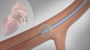 CardioMEMS Heart Failure