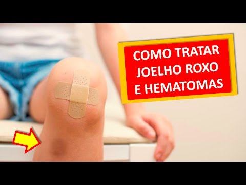 COMO TRATAR JOELHO ROXO E HEMATOMAS