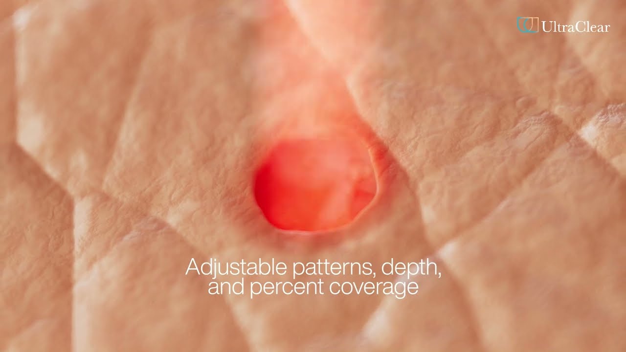 UltraClear® Laser Coring™ Animation