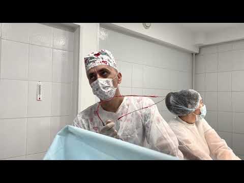 Видео 18+. Операция. Удаление варикозной вены на ноге и в паху. Флеболог Москва