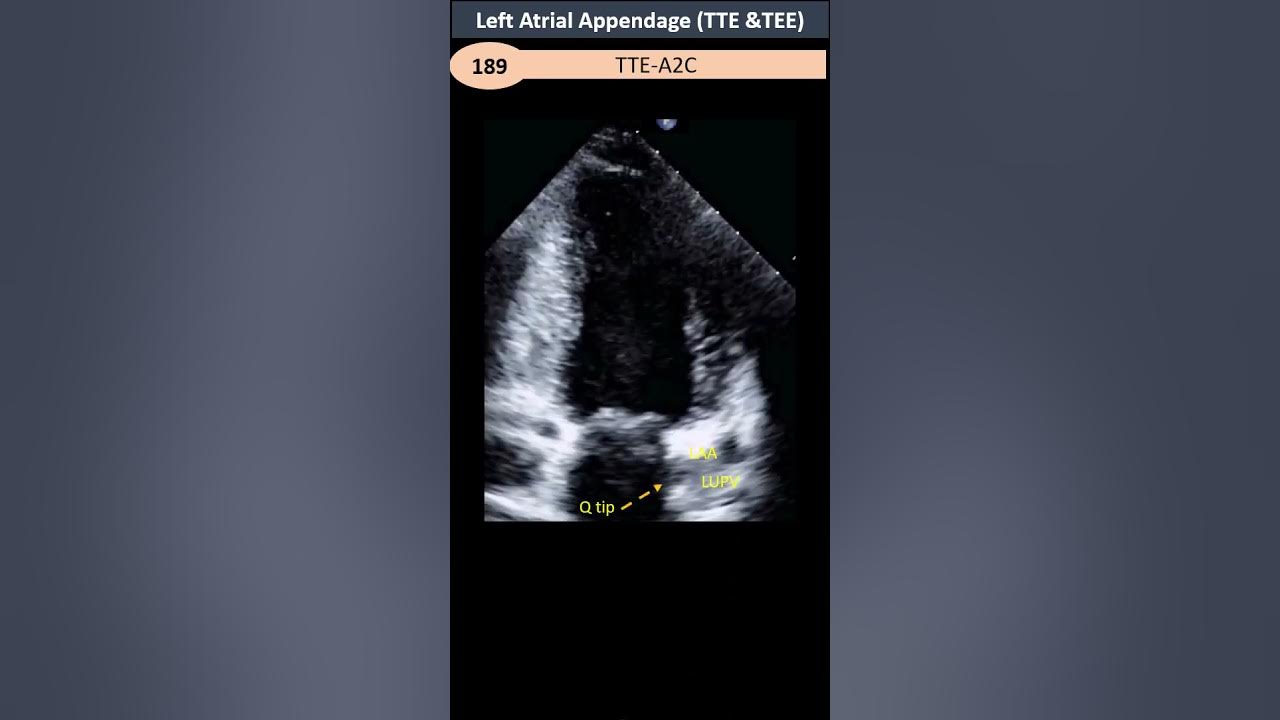 left-atrial-appendage-tte-tee-youtube