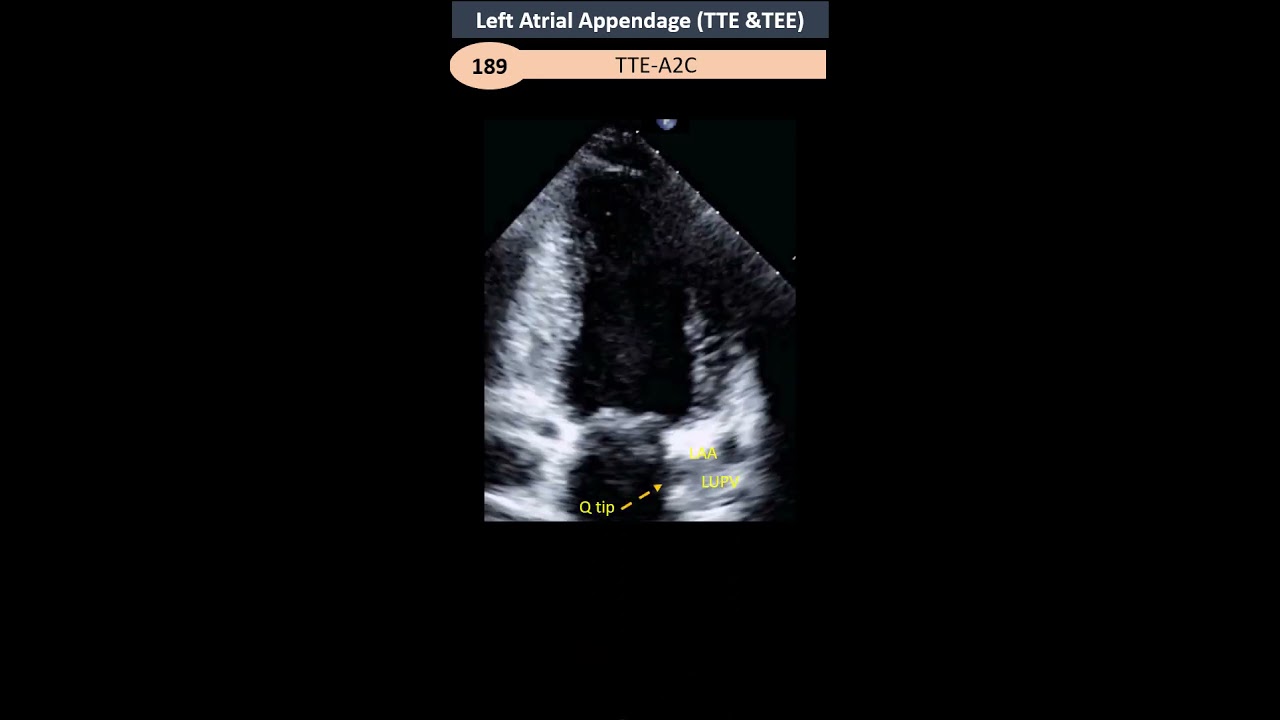 Left Atrial Appendage TTE TEE YouTube Left Atrial Appendage TTE TEE YouTube