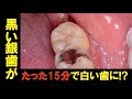 銀の詰め物を取り除いて本物のような自然な歯に‼︎ Remove the Filling and Become A Natural Tooth!!