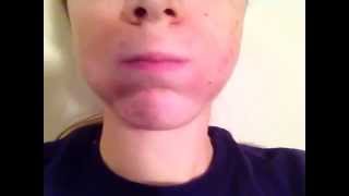 facial twitching spasm...is it essential tremor? don't know cause