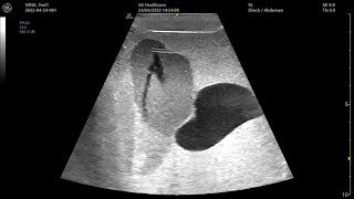 Robotic ultrasound scan of a prostate training phantom