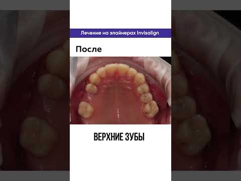 элайнеры invisalign - ортодонтическое лечение